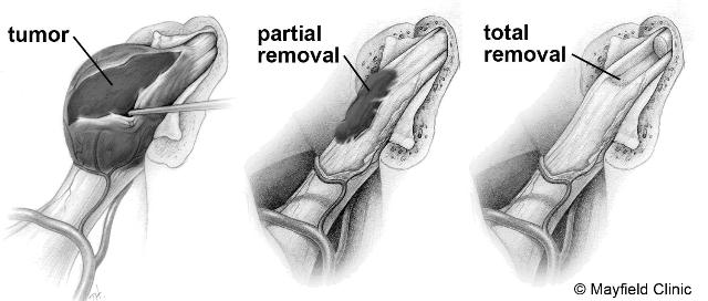 total_tumor_removal_website