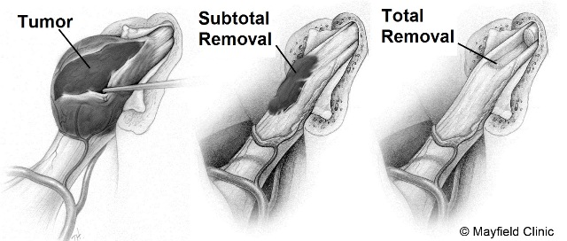 tumor_pic_for_website