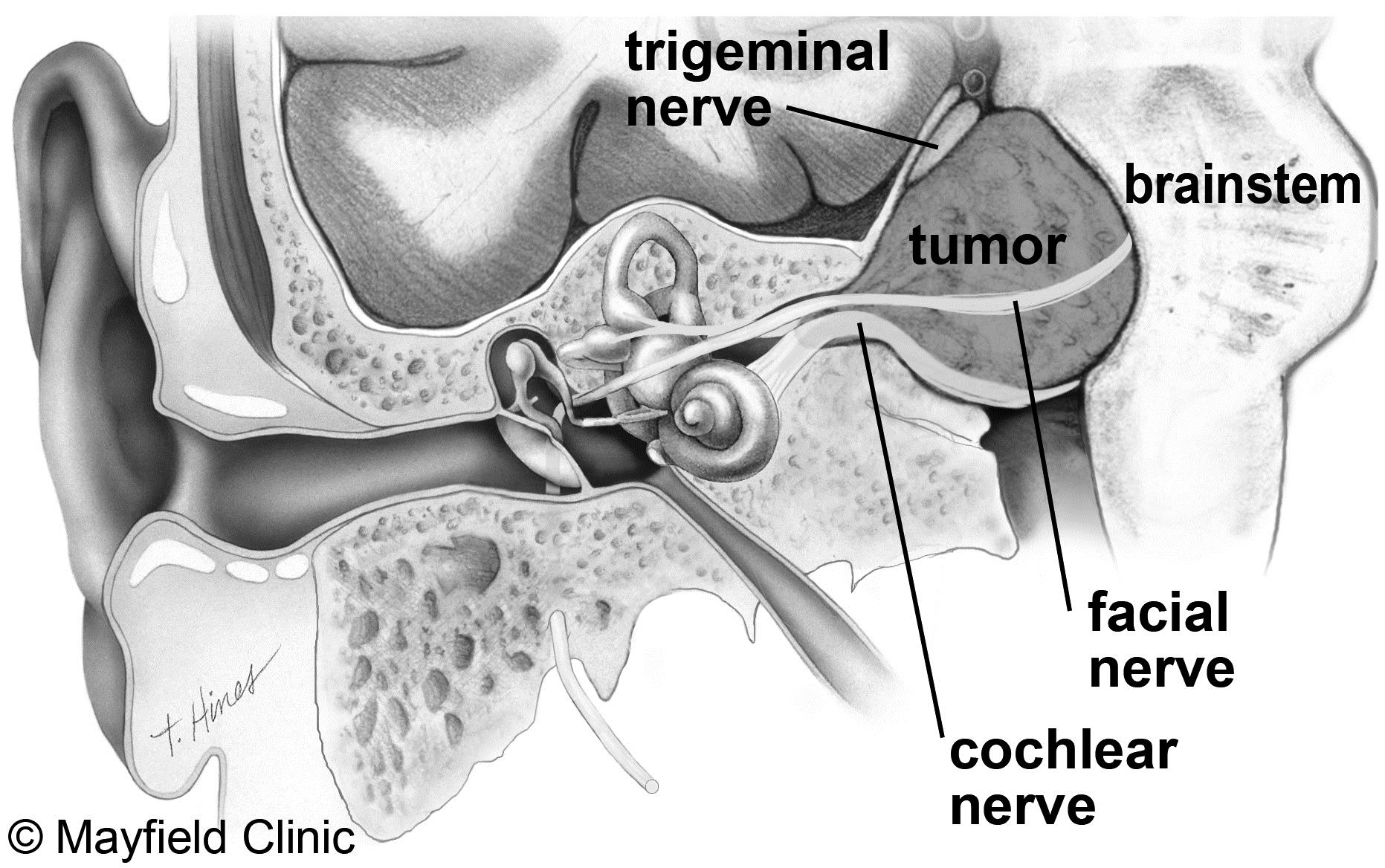 Acoustic Neuroma Facial Nerve 53