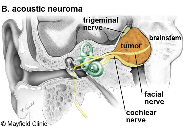 What is acoustic neuroma - Acoustic Neuroma Association