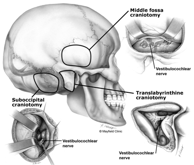 Mastoid surgery