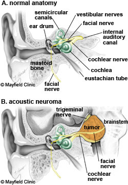 Acoustic Neuroma Facial Nerve 100